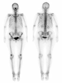 Nuclear medicine bone scan